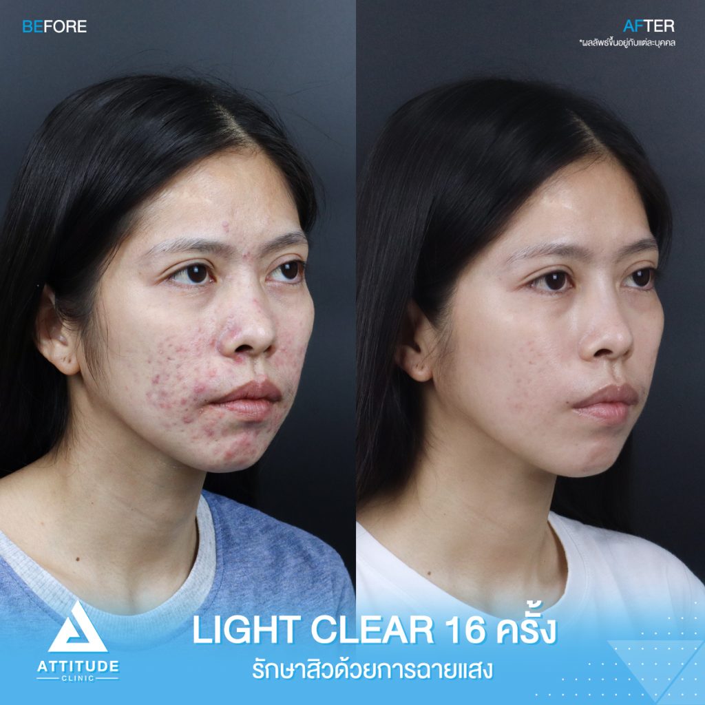 รีวิวรักษาสิวครบวงจร ผู้หญิง รีวิวรักษาสิวครบวงจร คุณกรกฎ โปรแกรม Light Clear 7 ขั้นตอน จำนวน 16 ครั้ง มีปัญหาสิวและรอยสิวจัดเต็ม หลังรักษาสิวตอนนี้หน้าใสวิ้ง ผิงเรียบเนียน มั่นใจสุดๆ