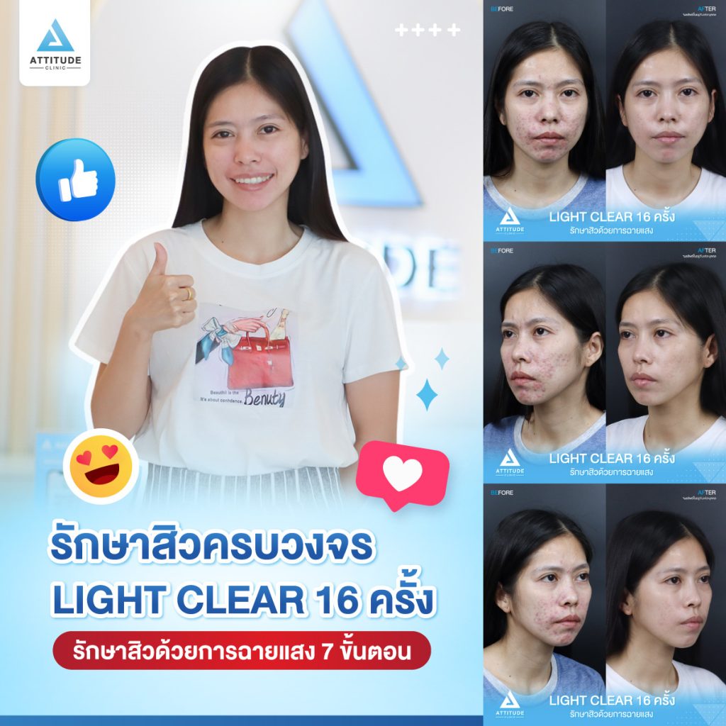 รีวิวรักษาสิวครบวงจร คุณกรกฎ โปรแกรม Light Clear 7 ขั้นตอน จำนวน 16 ครั้ง มีปัญหาสิวและรอยสิวจัดเต็ม หลังรักษาสิวตอนนี้หน้าใสวิ้ง ผิงเรียบเนียน มั่นใจสุดๆ