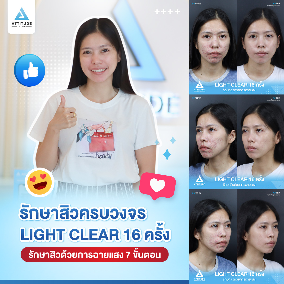 รีวิวรักษาสิวครบวงจร คุณกรกฎ โปรแกรม Light Clear 7 ขั้นตอน จำนวน 16 ครั้ง มีปัญหาสิวและรอยสิวจัดเต็ม หลังรักษาสิวตอนนี้หน้าใสวิ้ง ผิงเรียบเนียน มั่นใจสุดๆ