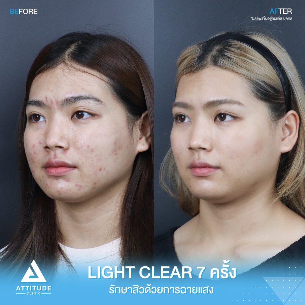 รีวิวรักษาสิวครบวงจร น้องเพลง โปรแกรม Light Clear 7 ขั้นตอน จำนวน 7 ครั้ง มีปัญหาสิวและรอยสิวจัดเต็ม หลังรักษาสิวตอนนี้หน้าใสวิ้ง ผิวเรียบเนียน มั่นใจขึ้นสุดๆ