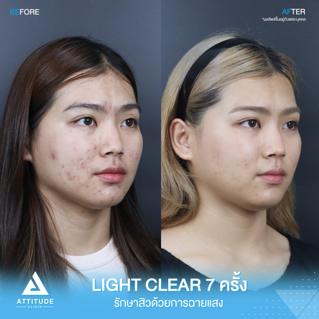 รีวิวรักษาสิวครบวงจร น้องเพลง โปรแกรม Light Clear 7 ขั้นตอน จำนวน 7 ครั้ง มีปัญหาสิวและรอยสิวจัดเต็ม หลังรักษาสิวตอนนี้หน้าใสวิ้ง ผิวเรียบเนียน มั่นใจขึ้นสุดๆ