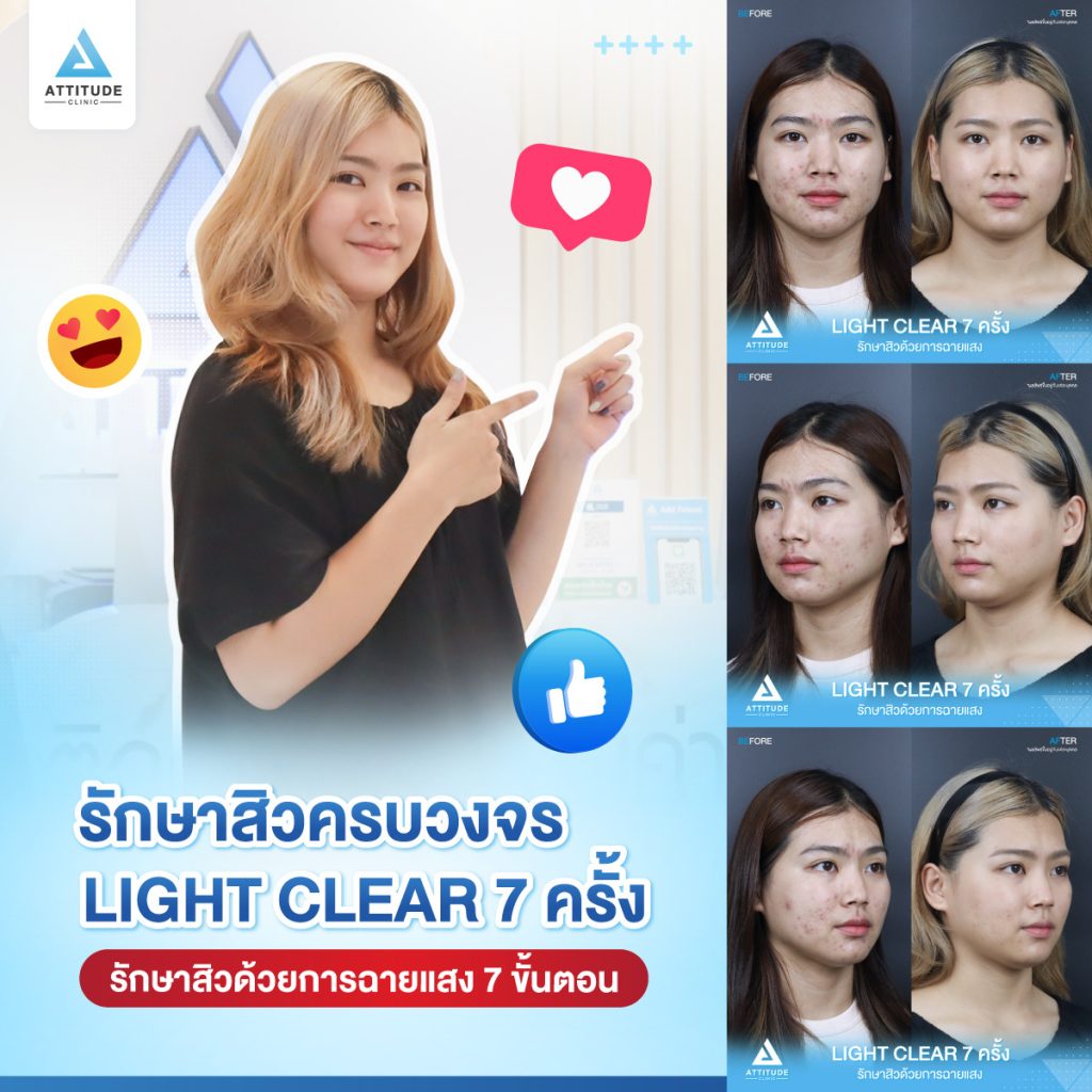 รีวิวรักษาสิวครบวงจร น้องเพลง โปรแกรม Light Clear 7 ขั้นตอน จำนวน 7 ครั้ง มีปัญหาสิวและรอยสิวจัดเต็ม หลังรักษาสิวตอนนี้หน้าใสวิ้ง ผิวเรียบเนียน มั่นใจขึ้นสุดๆ