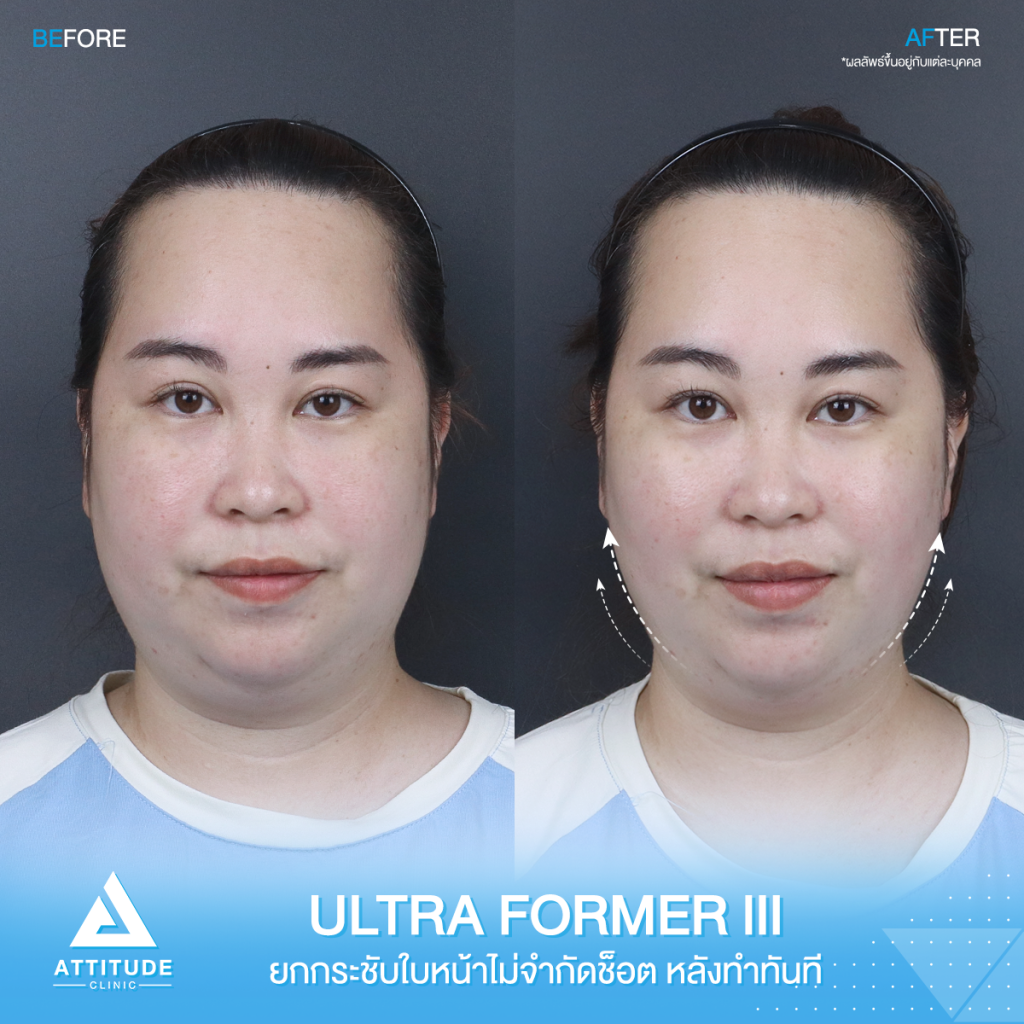 รีวิว Ultraformer iii