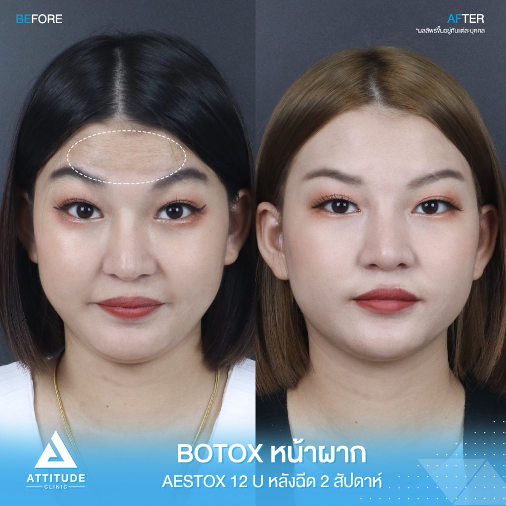 รีวิวฉีดโบท็อกซ์หน้าผาก Aestox เกาหลีพรีเมียม จำนวน 12 ยูนิต อัปเดตหลังฉีด 2 สัปดาห์ ริ้วไหนก็หายหมด หมอฉีดเองทุกเคส โบท็อกซ์แท้ คุณภาพ มาตรฐาน อย. ไทยที่ Attitude Clinic