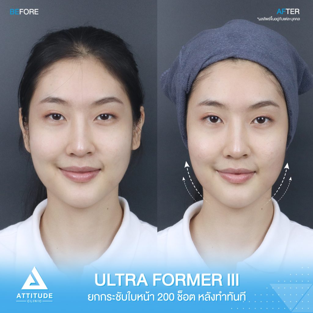 รีวิว Ultraformer iii