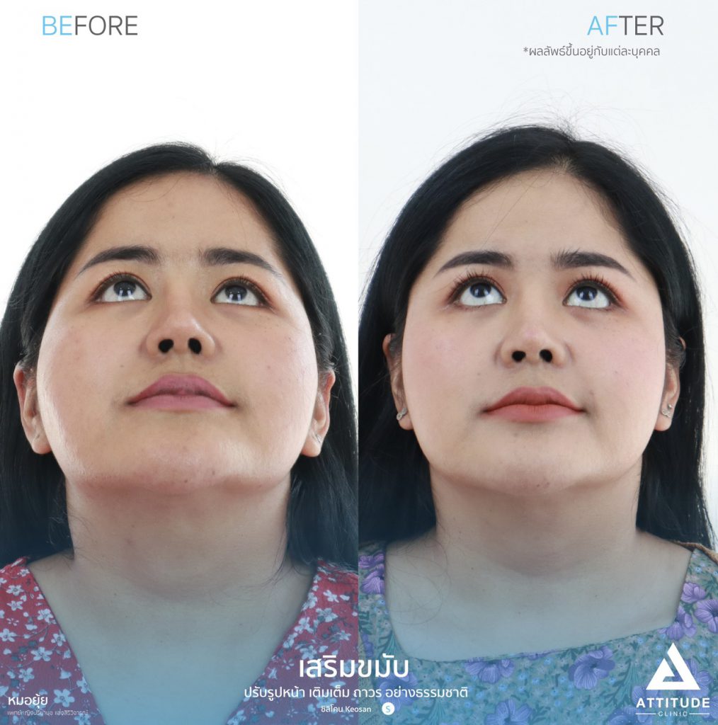 รูปรีวิวเสริมขมับด้วยซิลิโคน