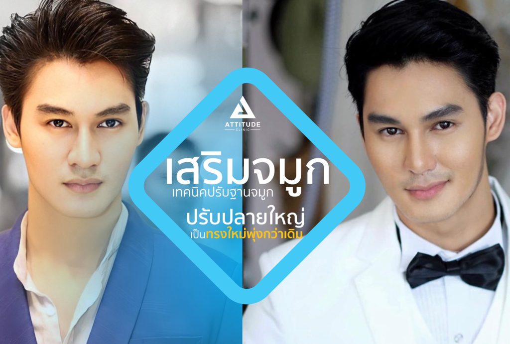 รีวิวเสริมจมูกผู้ชาย ทรงธรรมชาติ ไม่โป๊ะ ฝีมือหมอยุ้ย Attitude Clinic รัชดา