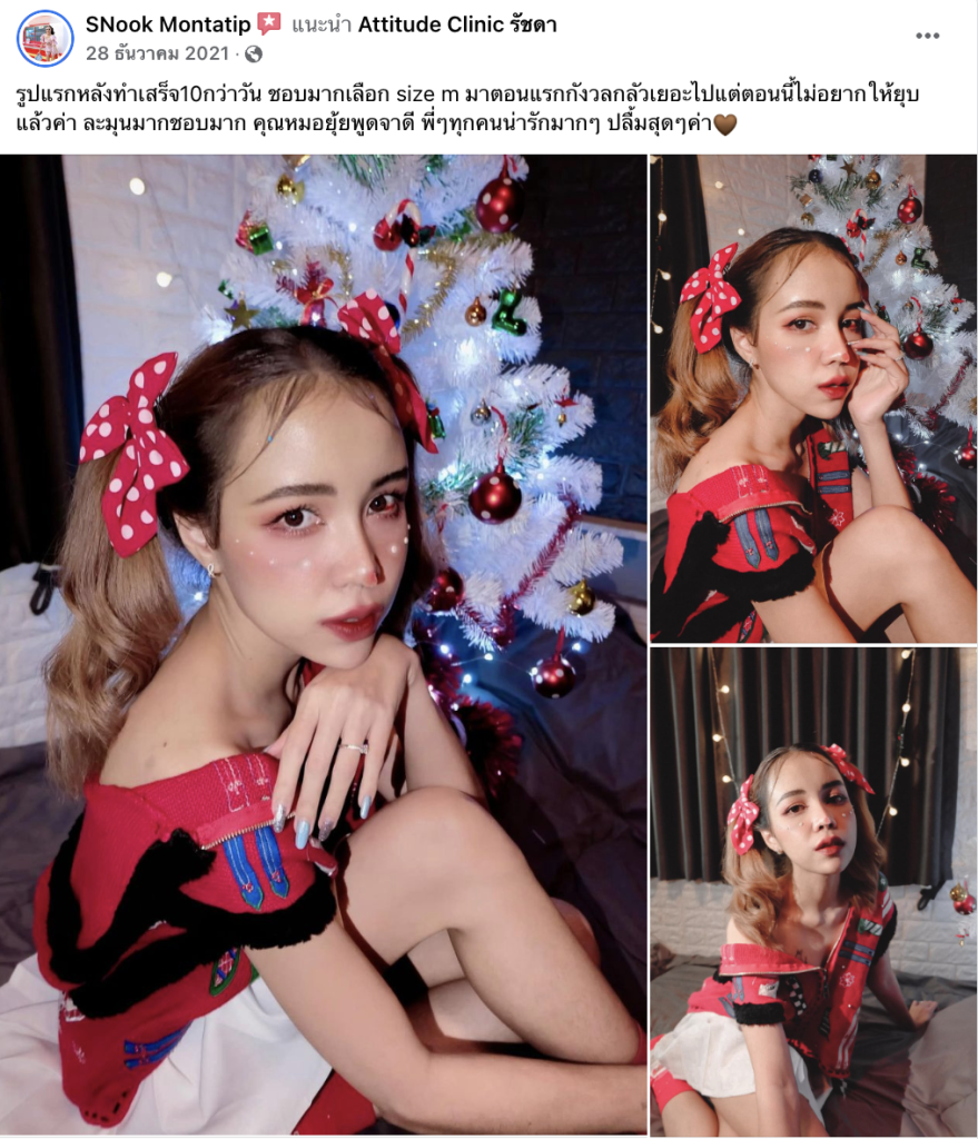 รีวิวเสริมหน้าผากด้วยซิลิโคน