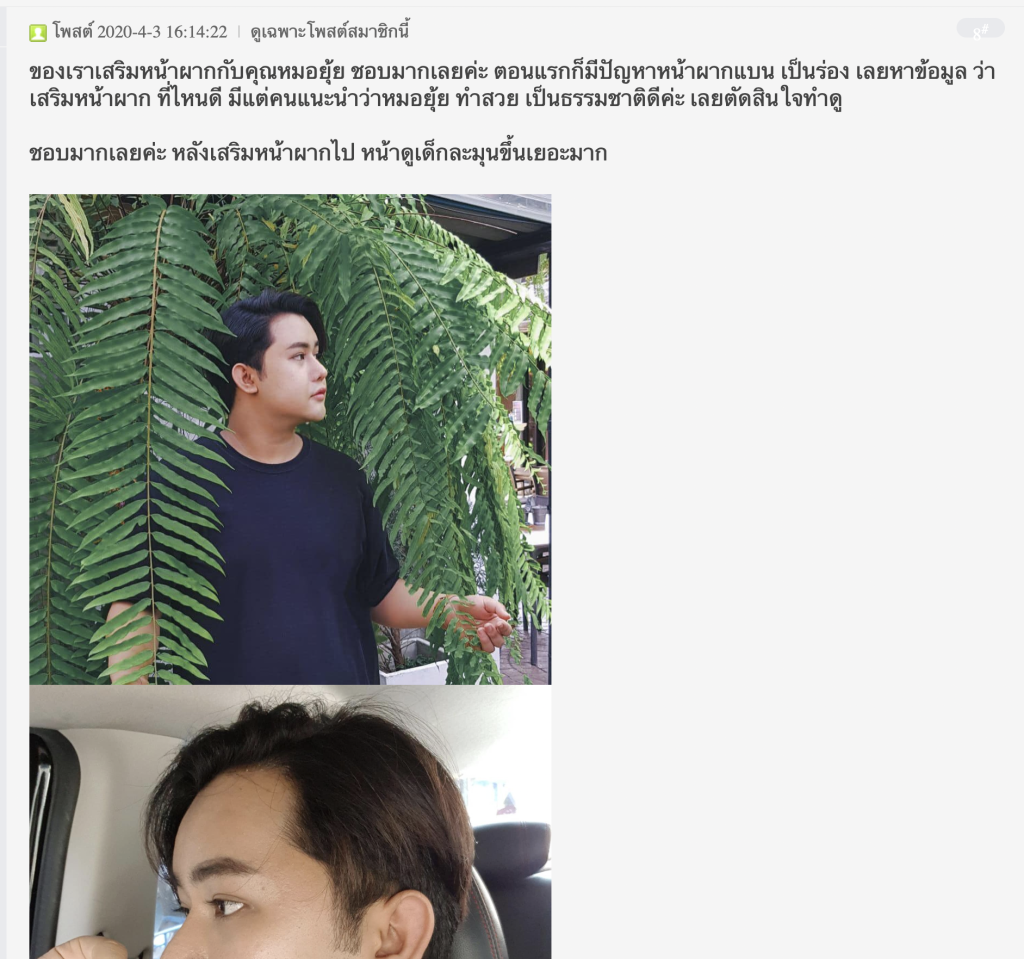 รีวิวเสริมหน้าผากด้วยซิลิโคน