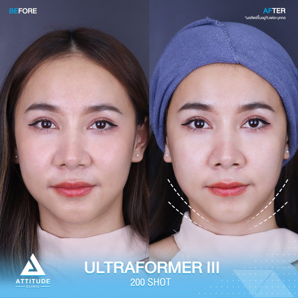 รีวิว Ultraformer iii