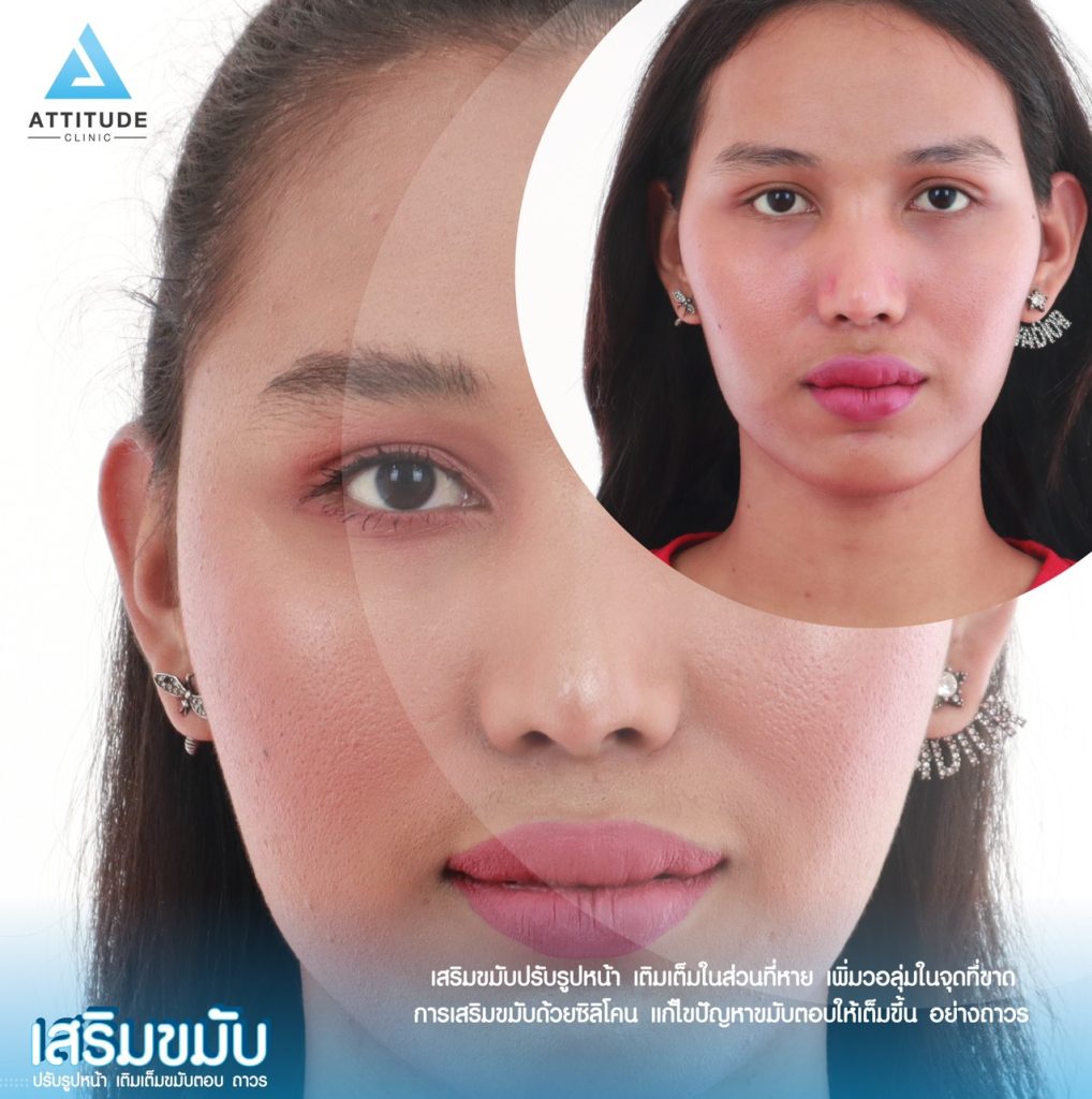 เสริมขมับด้วยซิลิโคนแผ่นแบบถาวร