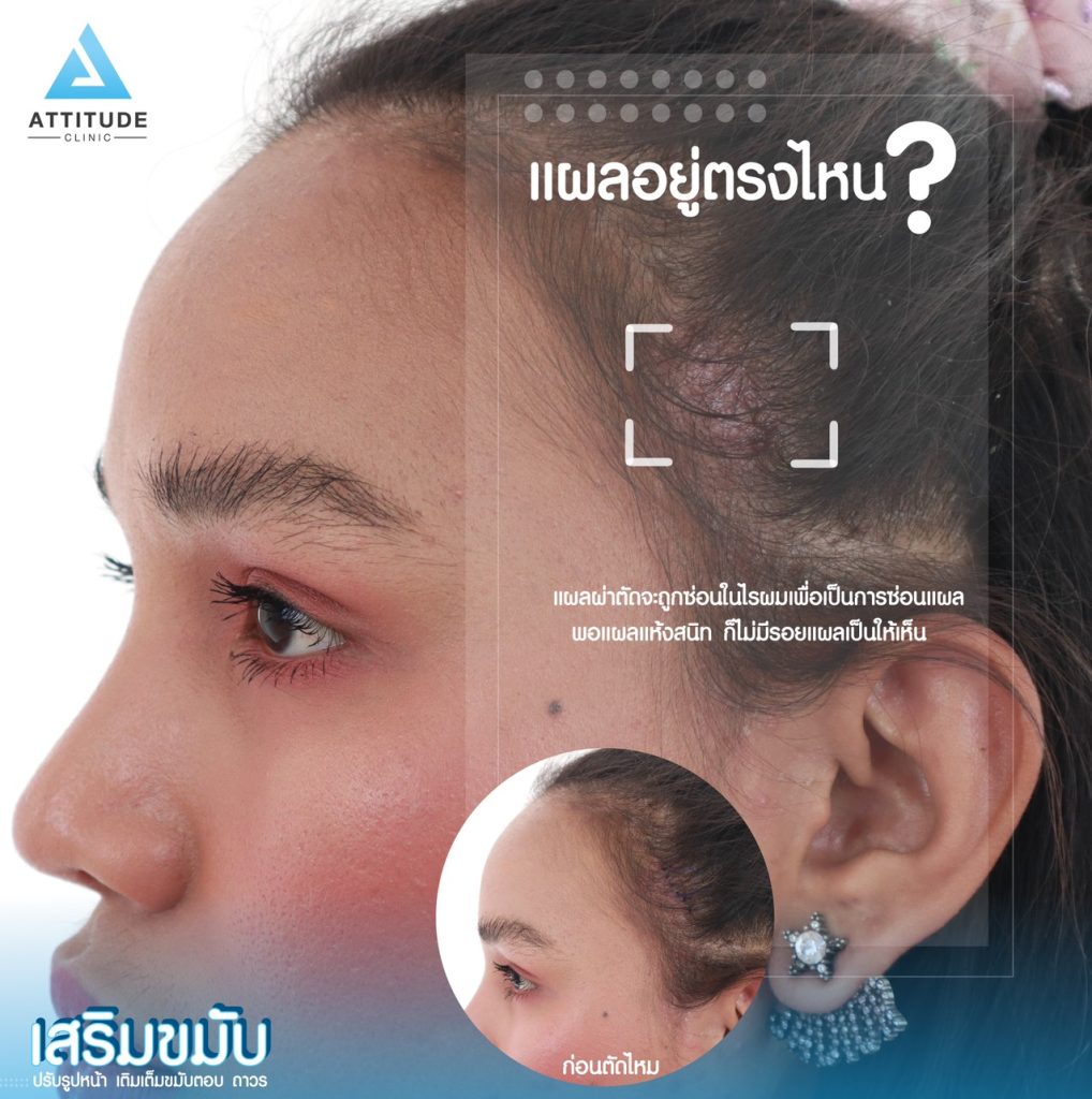 ตำแหน่งและขนาดแผล หลังเสริมขมับด้วยซิลิโคนแผ่น