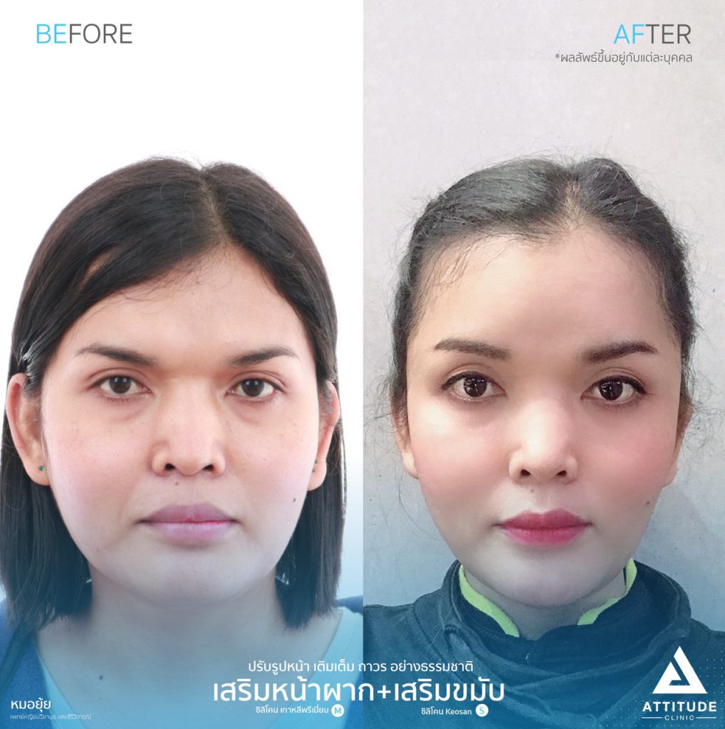 รูปรีวิวเสริมขมับด้วยซิลิโคน