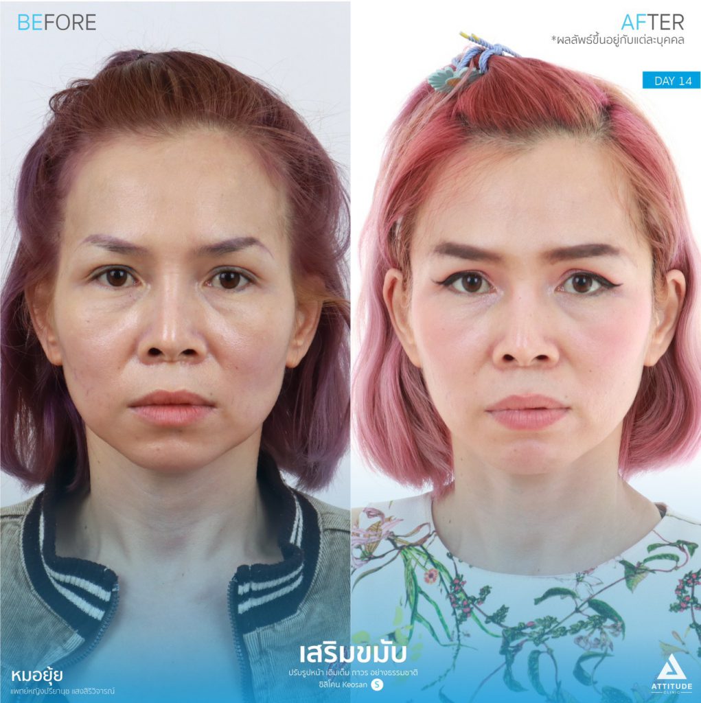 รูปรีวิวเสริมขมับด้วยซิลิโคน