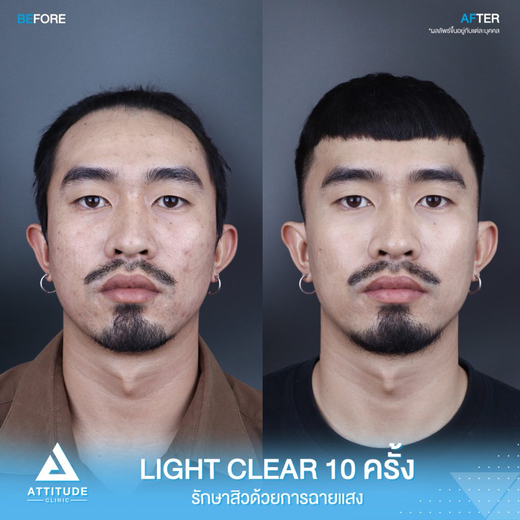 เปลี่ยนหนุ่มเซอร์ เป็นหนุ่มหน้าใส รีวิวรักษาสิวด้วยการฉายแสงโปรแกรม Light Clear 7 ขั้นตอน จำนวน 10 ครั้ง ของคุณนนท์