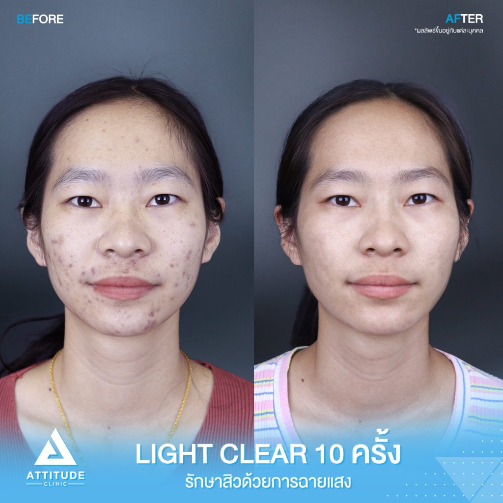 รีวิวรักษาสิวครบวงจร โปรแกรม Light Clear 7 ขั้นตอน จำนวน 10 ครั้ง ของคุณณัฐฑริกา มีปัญหาสิวและรอยสิวจัดเต็ม