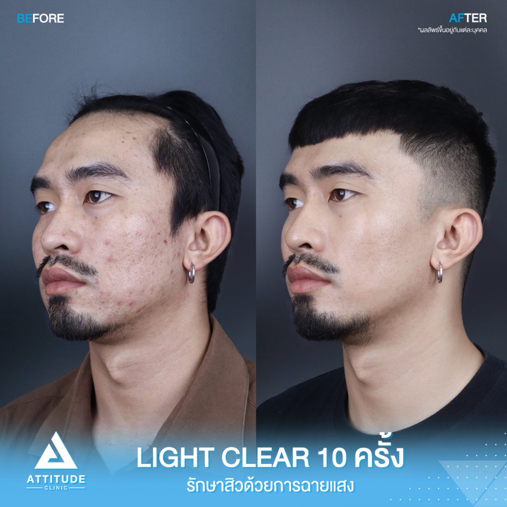 เปลี่ยนหนุ่มเซอร์ เป็นหนุ่มหน้าใส รีวิวรักษาสิวด้วยการฉายแสงโปรแกรม Light Clear 7 ขั้นตอน จำนวน 10 ครั้ง ของคุณนนท์