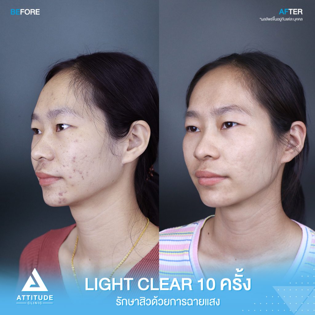 รีวิวรักษาสิวครบวงจร โปรแกรม Light Clear 7 ขั้นตอน จำนวน 10 ครั้ง ของคุณณัฐฑริกา มีปัญหาสิวและรอยสิวจัดเต็ม