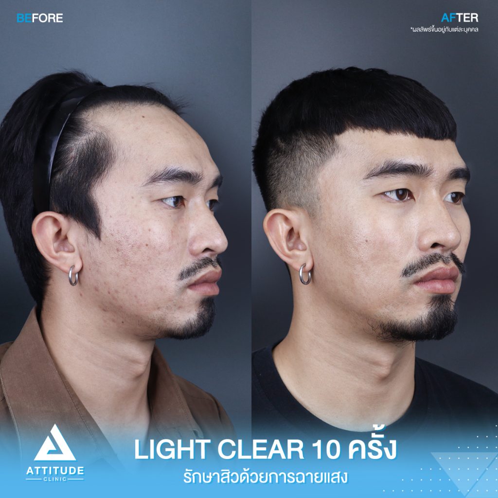 เปลี่ยนหนุ่มเซอร์ เป็นหนุ่มหน้าใส รีวิวรักษาสิวด้วยการฉายแสงโปรแกรม Light Clear 7 ขั้นตอน จำนวน 10 ครั้ง ของคุณนนท์