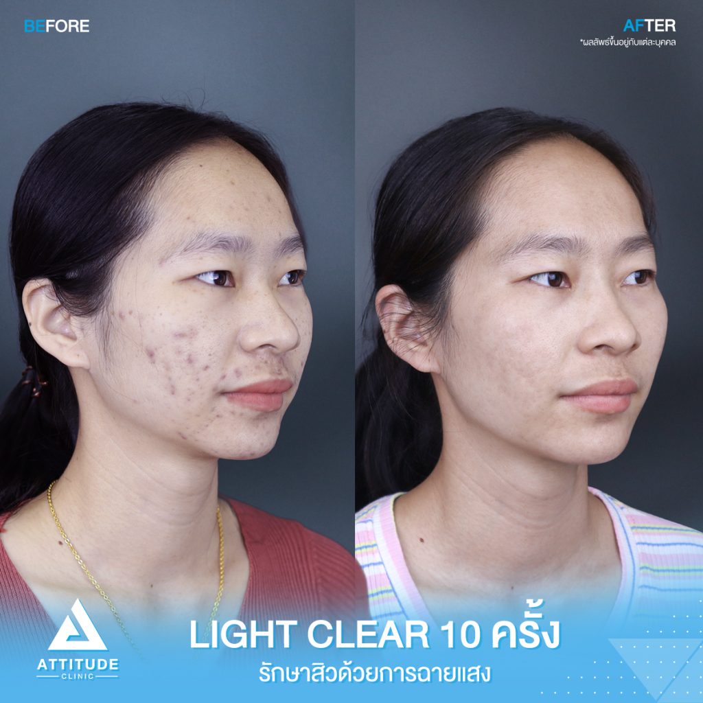 รีวิวรักษาสิวครบวงจร โปรแกรม Light Clear 7 ขั้นตอน จำนวน 10 ครั้ง ของคุณณัฐฑริกา มีปัญหาสิวและรอยสิวจัดเต็ม