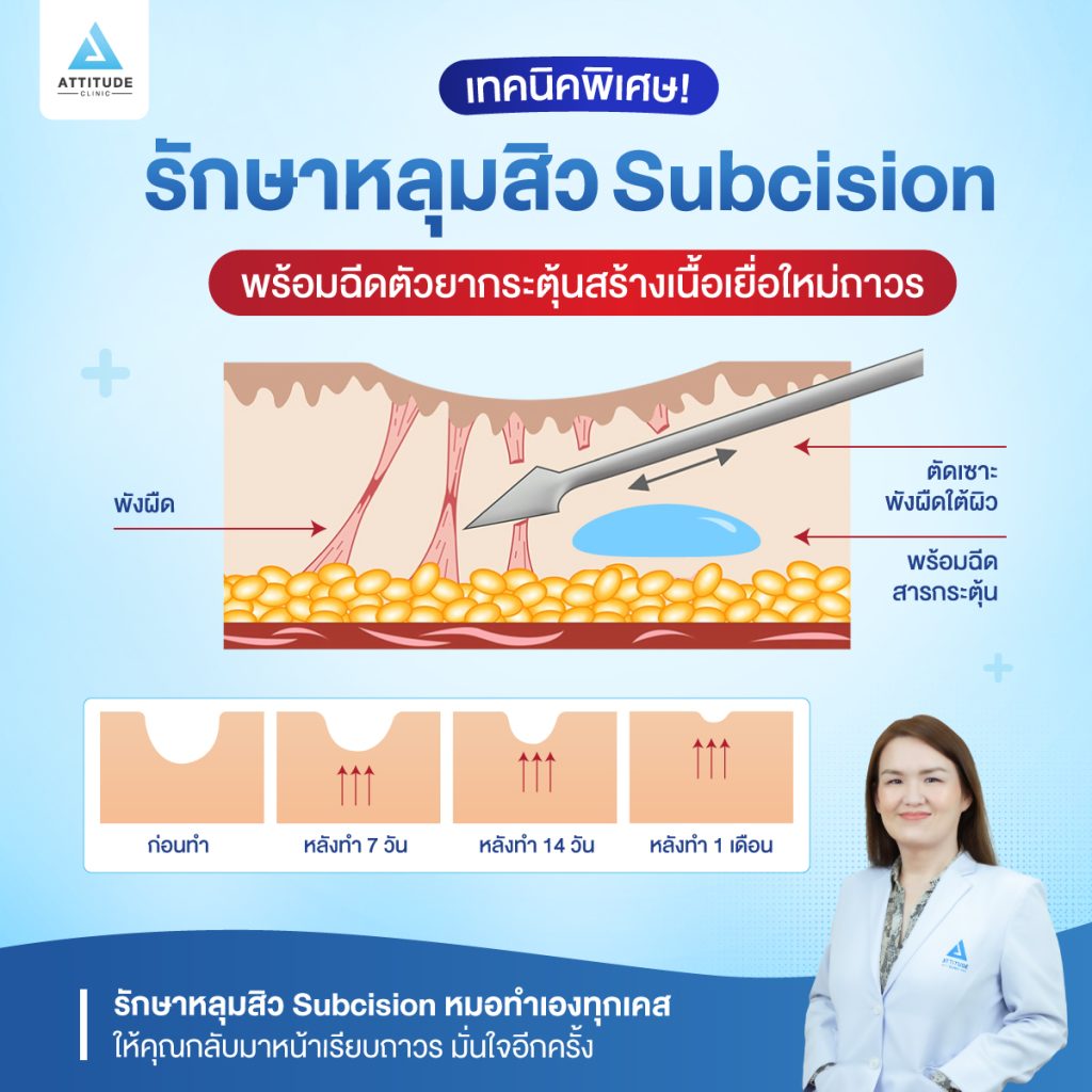 เทคนิคพิเศษ รักษาหลุมสิวแบบ Subcision พร้อมฉีดตัวยากระตุ้นสร้างเนื้อเยื่อใหม่ถาวร