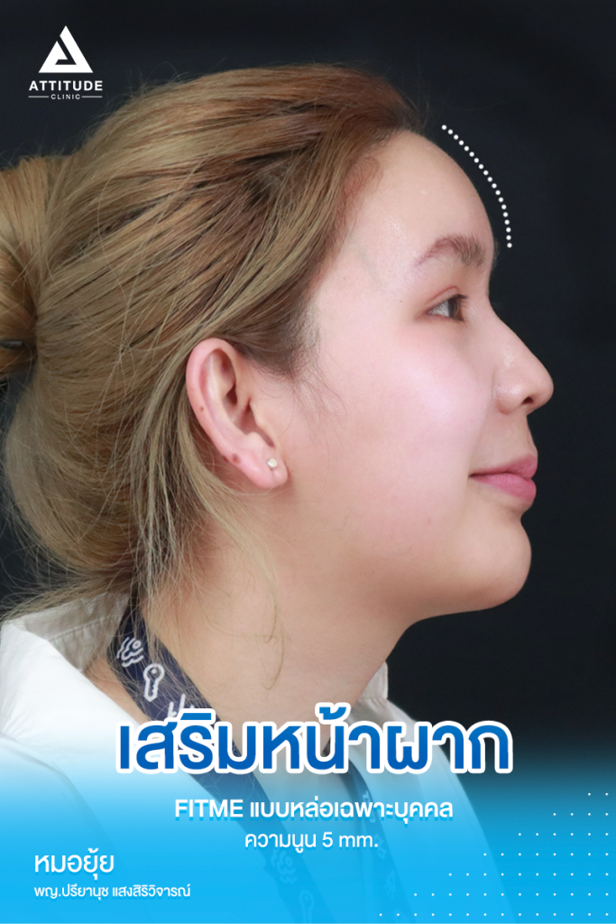 มั่นใจหน้าผากสวยมาก รีวิวเสริมหน้าผากคุณฟุ้ง S Curve ด้วยซิลิโคน Fitme แบบหล่อเฉพาะบุคคล แก้ปัญหาหน้าผากแบน ไม่เรียบเสมอกัน หน้าดูแข็ง ให้สวยฉ่ำ โดยคุณหมอยุ้ย