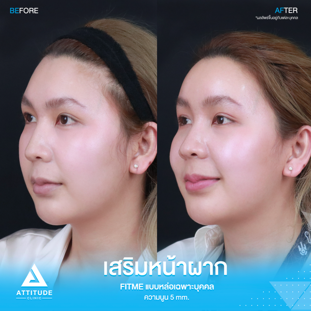 มั่นใจหน้าผากสวยมาก รีวิวเสริมหน้าผากคุณฟุ้ง S Curve ด้วยซิลิโคน Fitme แบบหล่อเฉพาะบุคคล แก้ปัญหาหน้าผากแบน ไม่เรียบเสมอกัน หน้าดูแข็ง ให้สวยฉ่ำ โดยคุณหมอยุ้ย