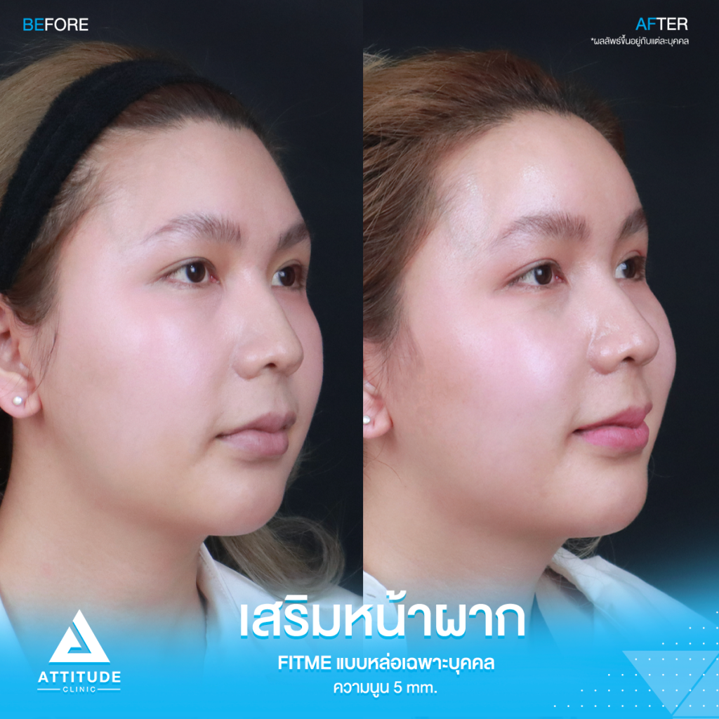 มั่นใจหน้าผากสวยมาก รีวิวเสริมหน้าผากคุณฟุ้ง S Curve ด้วยซิลิโคน Fitme แบบหล่อเฉพาะบุคคล แก้ปัญหาหน้าผากแบน ไม่เรียบเสมอกัน หน้าดูแข็ง ให้สวยฉ่ำ โดยคุณหมอยุ้ย
