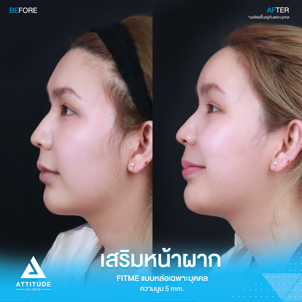 มั่นใจหน้าผากสวยมาก รีวิวเสริมหน้าผากคุณฟุ้ง S Curve ด้วยซิลิโคน Fitme แบบหล่อเฉพาะบุคคล แก้ปัญหาหน้าผากแบน ไม่เรียบเสมอกัน หน้าดูแข็ง ให้สวยฉ่ำ โดยคุณหมอยุ้ย