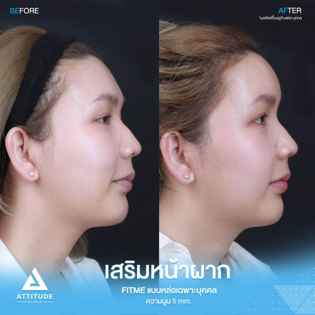 มั่นใจหน้าผากสวยมาก รีวิวเสริมหน้าผากคุณฟุ้ง S Curve ด้วยซิลิโคน Fitme แบบหล่อเฉพาะบุคคล แก้ปัญหาหน้าผากแบน ไม่เรียบเสมอกัน หน้าดูแข็ง ให้สวยฉ่ำ โดยคุณหมอยุ้ย
