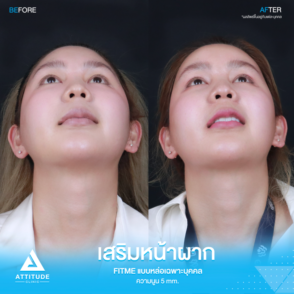 มั่นใจหน้าผากสวยมาก รีวิวเสริมหน้าผากคุณฟุ้ง S Curve ด้วยซิลิโคน Fitme แบบหล่อเฉพาะบุคคล แก้ปัญหาหน้าผากแบน ไม่เรียบเสมอกัน หน้าดูแข็ง ให้สวยฉ่ำ โดยคุณหมอยุ้ย