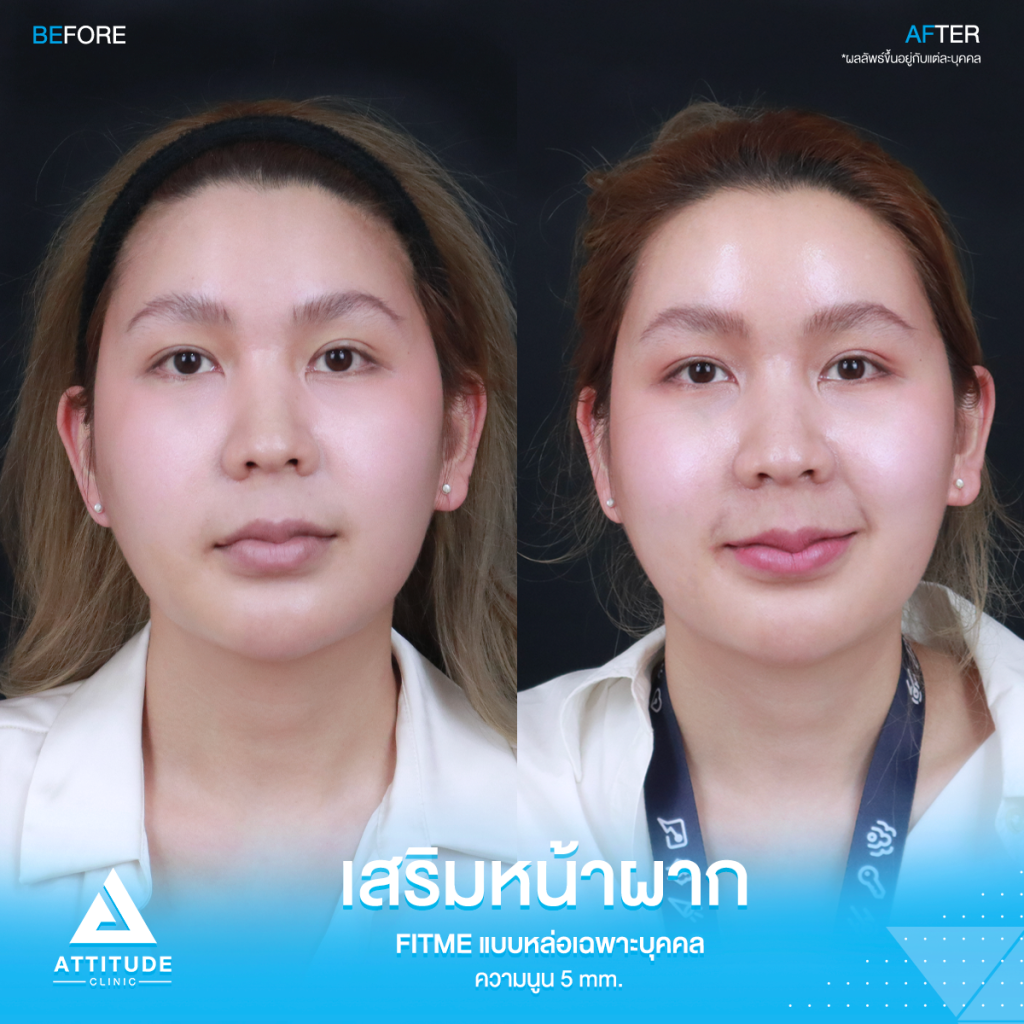 มั่นใจหน้าผากสวยมาก รีวิวเสริมหน้าผากคุณฟุ้ง S Curve ด้วยซิลิโคน Fitme แบบหล่อเฉพาะบุคคล แก้ปัญหาหน้าผากแบน ไม่เรียบเสมอกัน หน้าดูแข็ง ให้สวยฉ่ำ โดยคุณหมอยุ้ย