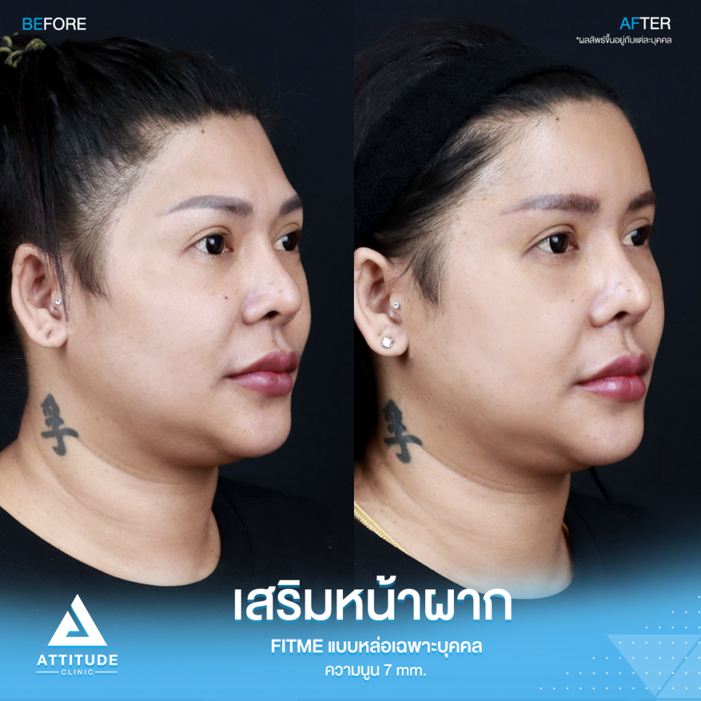 รีวิวเสริมหน้าผากคุณปุ้ย อยากหน้าหวานมาหาหมอยุ้ย !! รีวิวเสริมหน้าผากคุณปุ้ย ด้วยซิลิโคน Fitme แบบหล่อเฉพาะบุคคล แก้หน้าผากไม่เรียบ โหนกคิ้วสูง ด้วยความนูน 7 mm. โดยคุณหมอยุ้ย