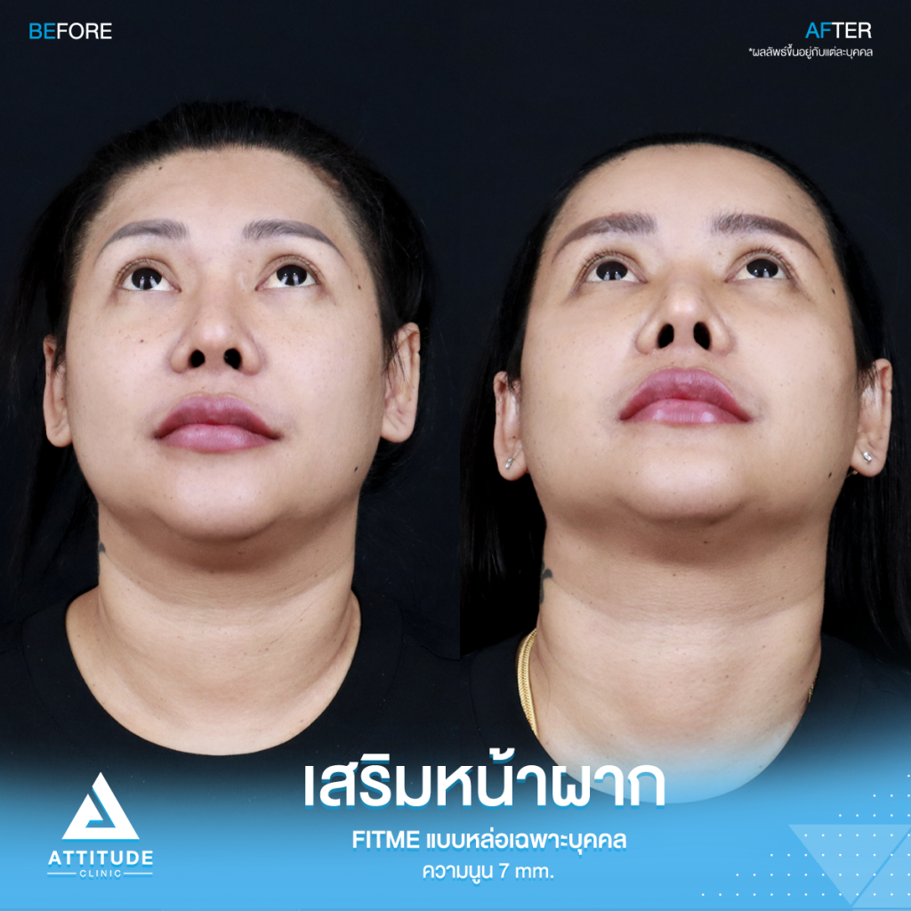 รีวิวเสริมหน้าผากคุณปุ้ย อยากหน้าหวานมาหาหมอยุ้ย !! รีวิวเสริมหน้าผากคุณปุ้ย ด้วยซิลิโคน Fitme แบบหล่อเฉพาะบุคคล แก้หน้าผากไม่เรียบ โหนกคิ้วสูง ด้วยความนูน 7 mm. โดยคุณหมอยุ้ย