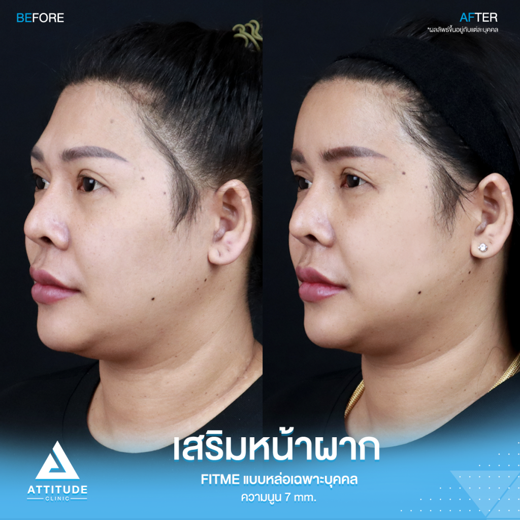 รีวิวเสริมหน้าผากคุณปุ้ย อยากหน้าหวานมาหาหมอยุ้ย !! รีวิวเสริมหน้าผากคุณปุ้ย ด้วยซิลิโคน Fitme แบบหล่อเฉพาะบุคคล แก้หน้าผากไม่เรียบ โหนกคิ้วสูง ด้วยความนูน 7 mm. โดยคุณหมอยุ้ย