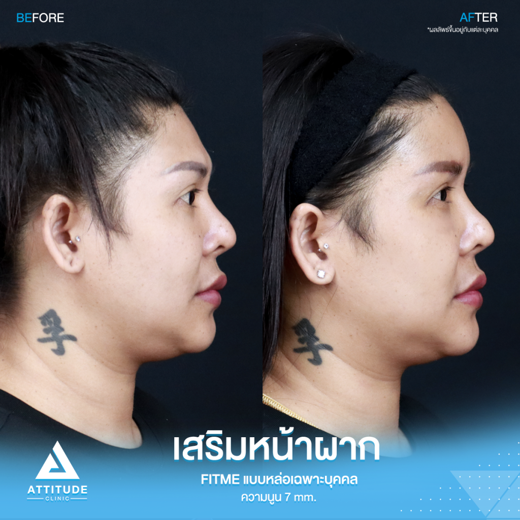 รีวิวเสริมหน้าผากคุณปุ้ย อยากหน้าหวานมาหาหมอยุ้ย !! รีวิวเสริมหน้าผากคุณปุ้ย ด้วยซิลิโคน Fitme แบบหล่อเฉพาะบุคคล แก้หน้าผากไม่เรียบ โหนกคิ้วสูง ด้วยความนูน 7 mm. โดยคุณหมอยุ้ย