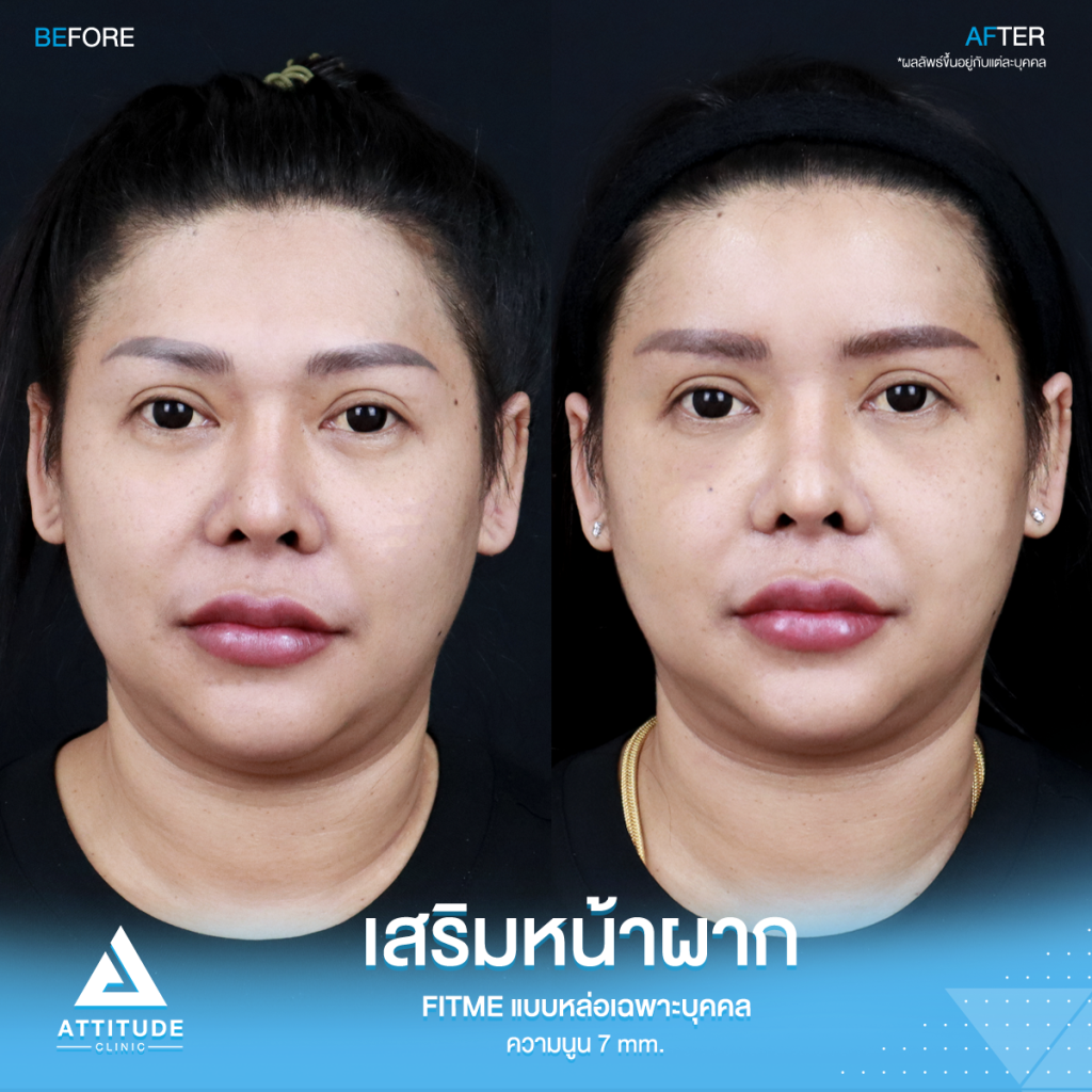 รีวิวเสริมหน้าผากคุณปุ้ย อยากหน้าหวานมาหาหมอยุ้ย !! รีวิวเสริมหน้าผากคุณปุ้ย ด้วยซิลิโคน Fitme แบบหล่อเฉพาะบุคคล แก้หน้าผากไม่เรียบ โหนกคิ้วสูง ด้วยความนูน 7 mm. โดยคุณหมอยุ้ย