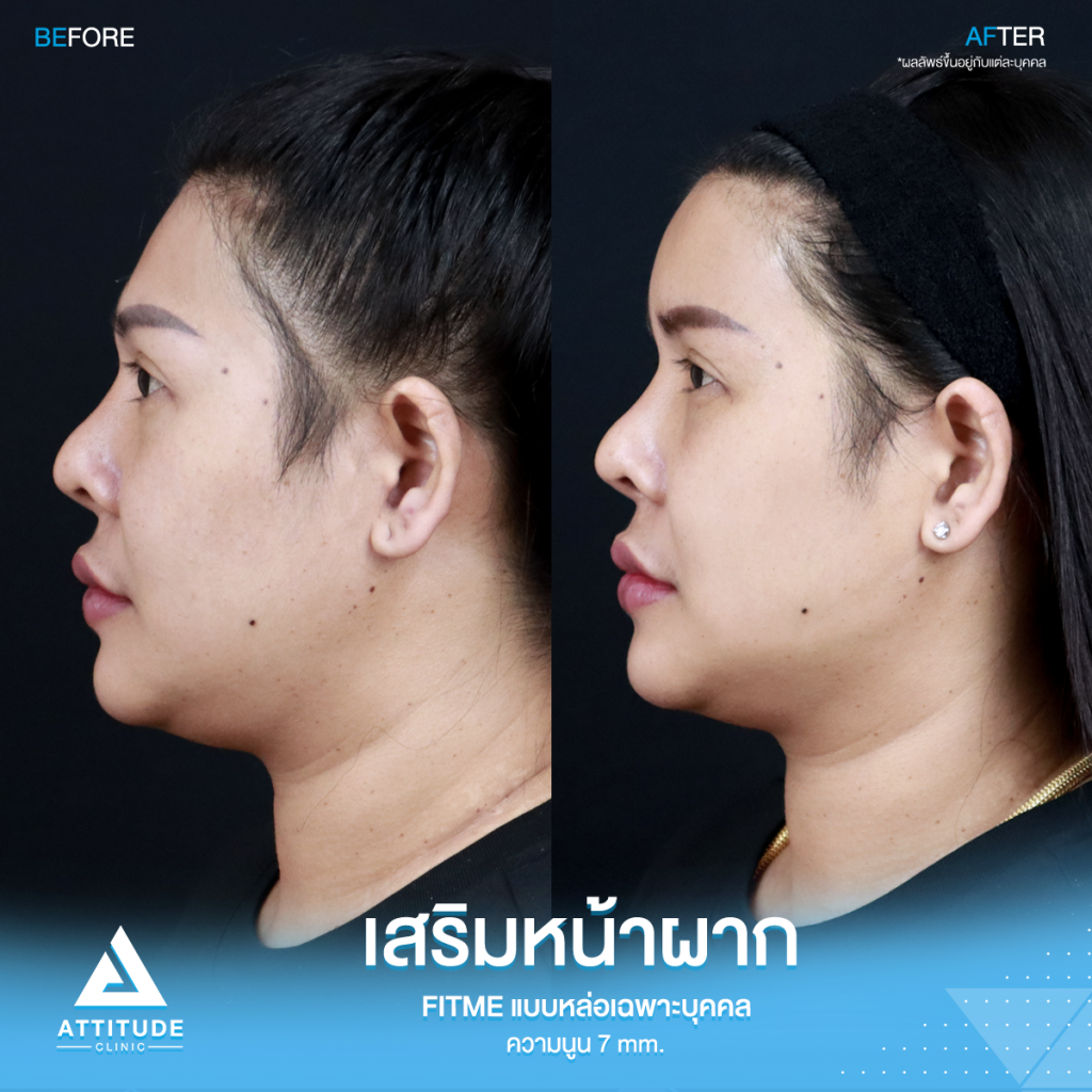 รีวิวเสริมหน้าผากคุณปุ้ย อยากหน้าหวานมาหาหมอยุ้ย !! รีวิวเสริมหน้าผากคุณปุ้ย ด้วยซิลิโคน Fitme แบบหล่อเฉพาะบุคคล แก้หน้าผากไม่เรียบ โหนกคิ้วสูง ด้วยความนูน 7 mm. โดยคุณหมอยุ้ย