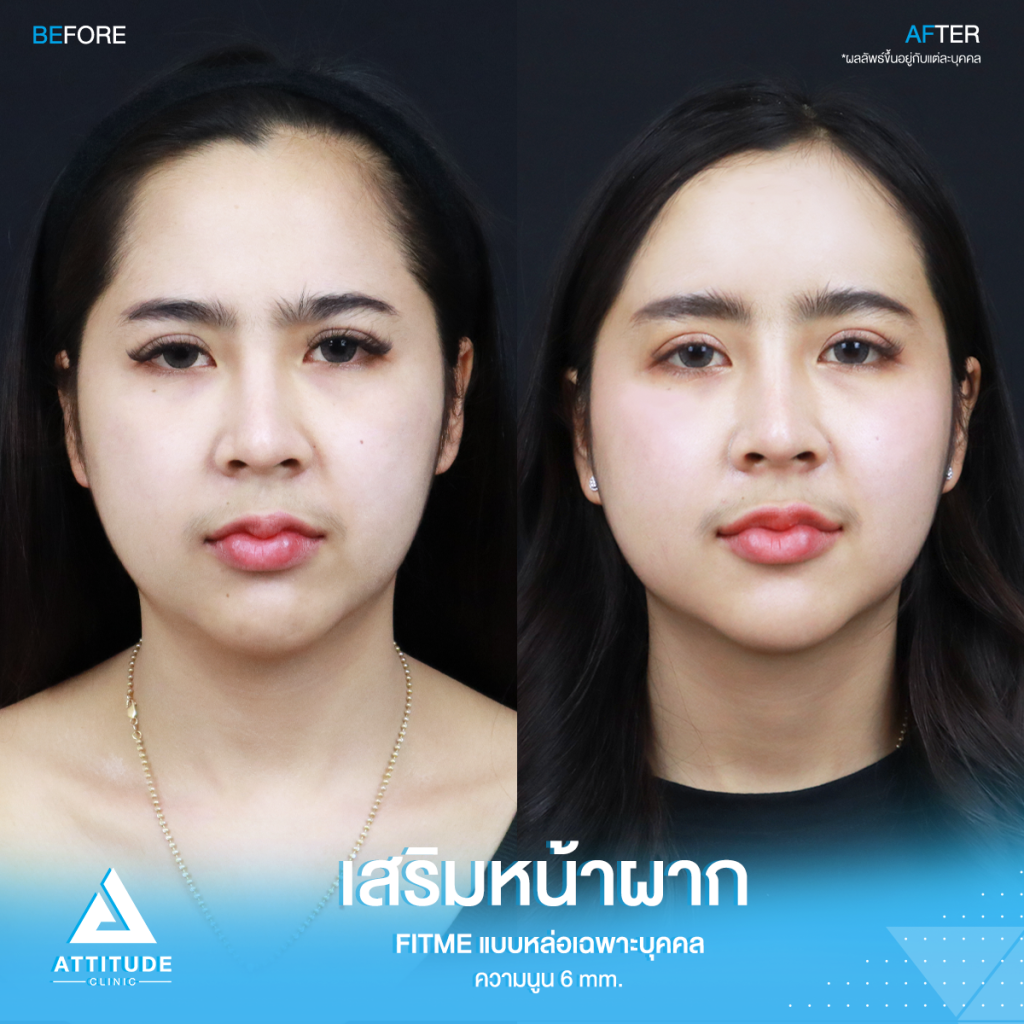เปลี่ยนลุคใหม่! หน้าผากสวย รีวิวเสริมหน้าผากคุณโบว์ ด้วยซิลิโคน Fitme แบบหล่อเฉพาะบุคคล แก้หน้าผากแบน ไม่มีมิติ หน้าแข็งทื่อ โดยคุณหมอยุ้ย