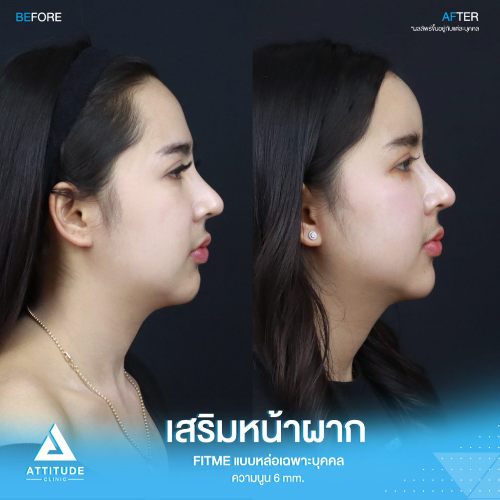 เปลี่ยนลุคใหม่! หน้าผากสวย รีวิวเสริมหน้าผากคุณโบว์ ด้วยซิลิโคน Fitme แบบหล่อเฉพาะบุคคล แก้หน้าผากแบน ไม่มีมิติ หน้าแข็งทื่อ โดยคุณหมอยุ้ย