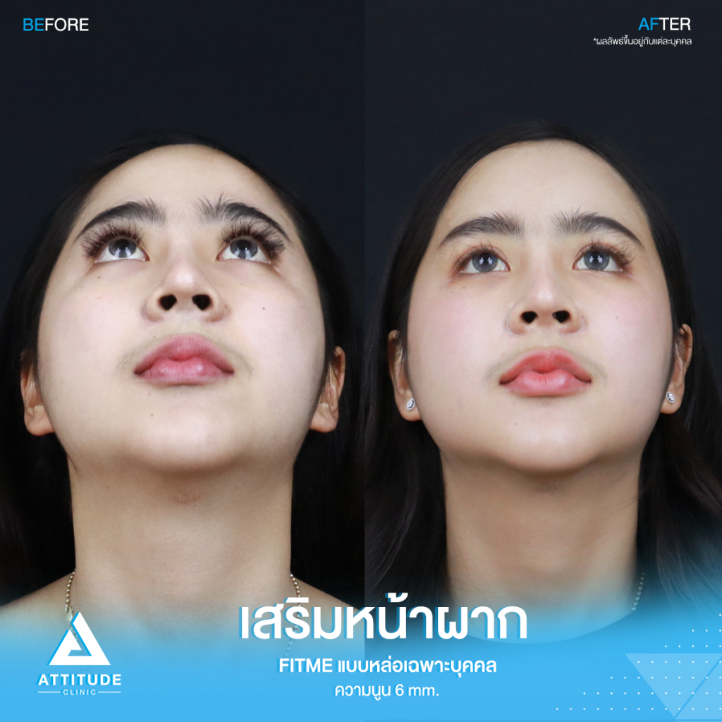 เปลี่ยนลุคใหม่! หน้าผากสวย รีวิวเสริมหน้าผากคุณโบว์ ด้วยซิลิโคน Fitme แบบหล่อเฉพาะบุคคล แก้หน้าผากแบน ไม่มีมิติ หน้าแข็งทื่อ โดยคุณหมอยุ้ย