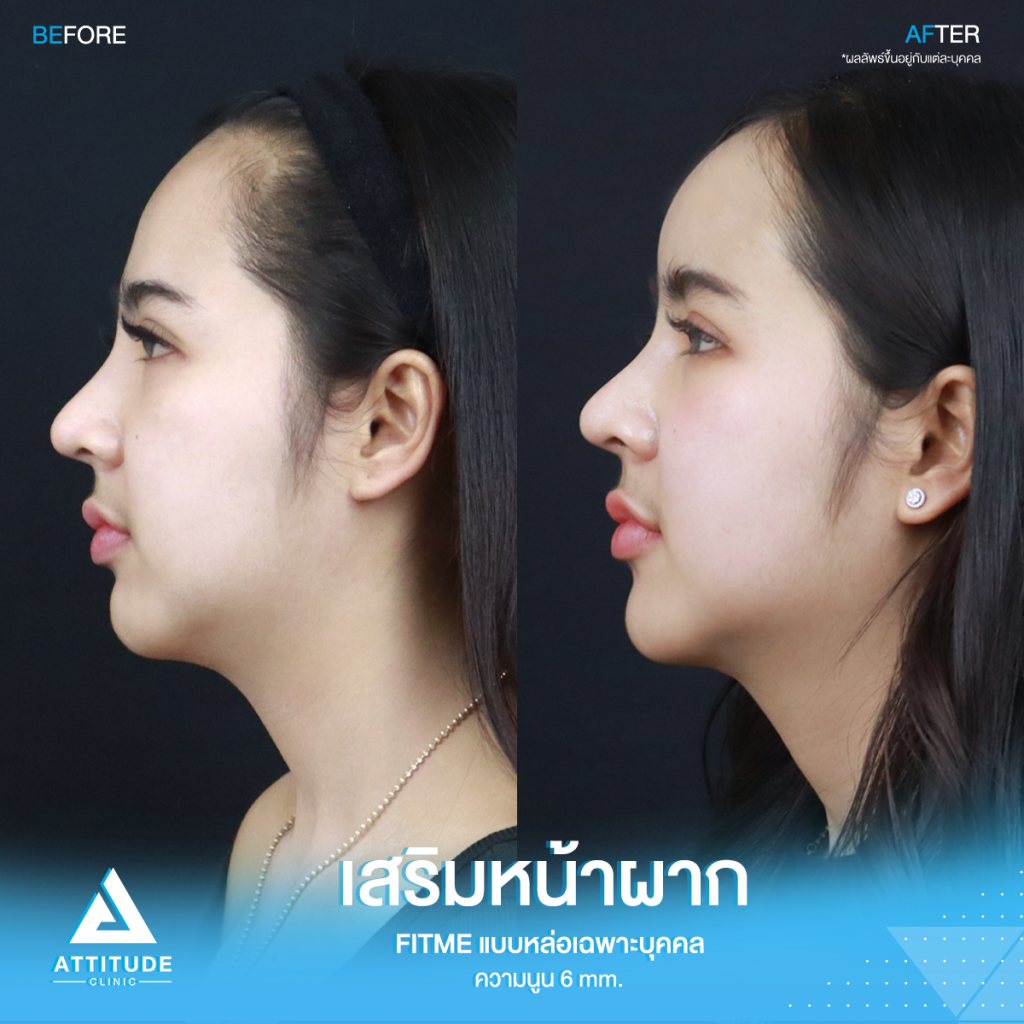เปลี่ยนลุคใหม่! หน้าผากสวย รีวิวเสริมหน้าผากคุณโบว์ ด้วยซิลิโคน Fitme แบบหล่อเฉพาะบุคคล แก้หน้าผากแบน ไม่มีมิติ หน้าแข็งทื่อ โดยคุณหมอยุ้ย