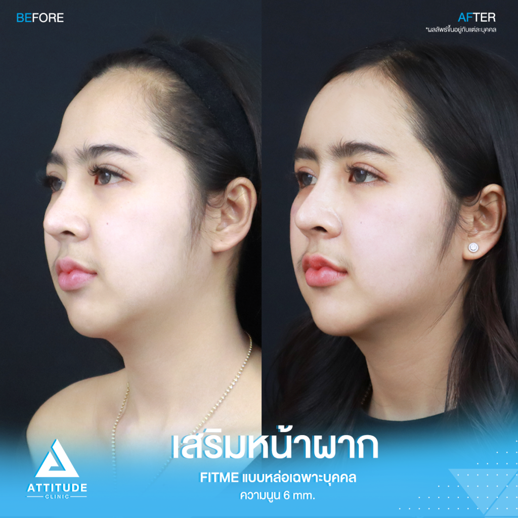 เปลี่ยนลุคใหม่! หน้าผากสวย รีวิวเสริมหน้าผากคุณโบว์ ด้วยซิลิโคน Fitme แบบหล่อเฉพาะบุคคล แก้หน้าผากแบน ไม่มีมิติ หน้าแข็งทื่อ โดยคุณหมอยุ้ย