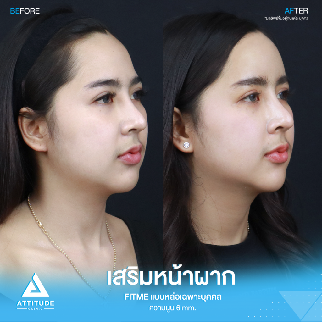 เปลี่ยนลุคใหม่! หน้าผากสวย รีวิวเสริมหน้าผากคุณโบว์ ด้วยซิลิโคน Fitme แบบหล่อเฉพาะบุคคล แก้หน้าผากแบน ไม่มีมิติ หน้าแข็งทื่อ โดยคุณหมอยุ้ย