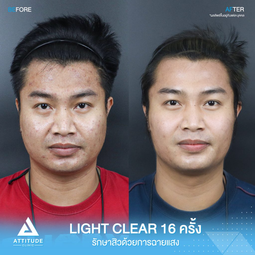 รีวิวรักษาสิวครบวงจร คุณเจ โปรแกรม Light Clear 7 ขั้นตอน จำนวน 16 ครั้ง มีปัญหาสิวและรอยสิวจัดเต็ม หลังรักษาสิวตอนนี้หน้าใสขึ้น ผิวเรียบเนียนขึ้น มั่นใจขึ้นสุดๆ