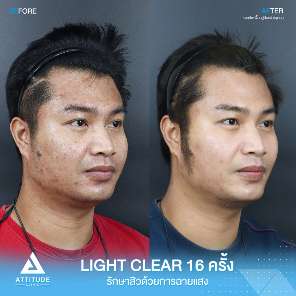 รีวิวรักษาสิวครบวงจร คุณเจ โปรแกรม Light Clear 7 ขั้นตอน จำนวน 16 ครั้ง มีปัญหาสิวและรอยสิวจัดเต็ม หลังรักษาสิวตอนนี้หน้าใสขึ้น ผิวเรียบเนียนขึ้น มั่นใจขึ้นสุดๆ