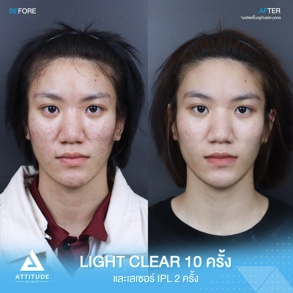 เปลี่ยนหน้าสิว เป็นหน้าใส รีวิวรักษาสิวด้วยการฉายแสง โปรแกรม Light Clear 7 ขั้นตอน จำนวน 10 ครั้ง และเลซอร์หน้าใส IPL จำนวน 2 ครั้ง น้องประทานพร