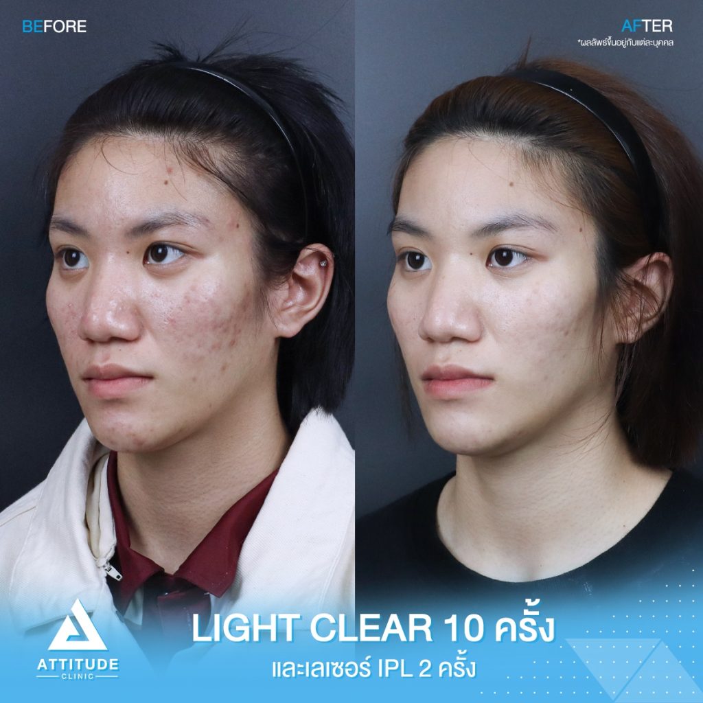 เปลี่ยนหน้าสิว เป็นหน้าใส รีวิวรักษาสิวด้วยการฉายแสง โปรแกรม Light Clear 7 ขั้นตอน จำนวน 10 ครั้ง และเลซอร์หน้าใส IPL จำนวน 2 ครั้ง น้องประทานพร