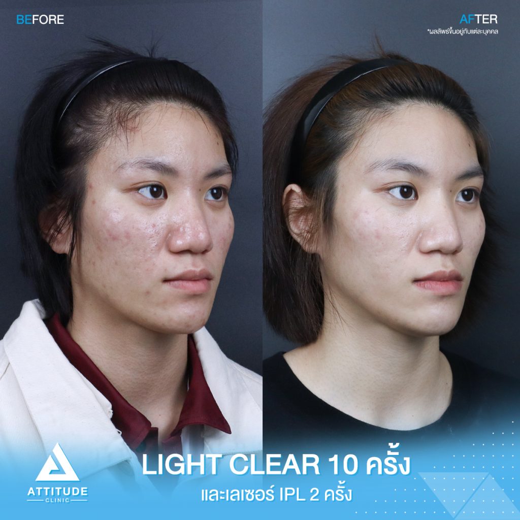 เปลี่ยนหน้าสิว เป็นหน้าใส รีวิวรักษาสิวด้วยการฉายแสง โปรแกรม Light Clear 7 ขั้นตอน จำนวน 10 ครั้ง และเลซอร์หน้าใส IPL จำนวน 2 ครั้ง น้องประทานพร