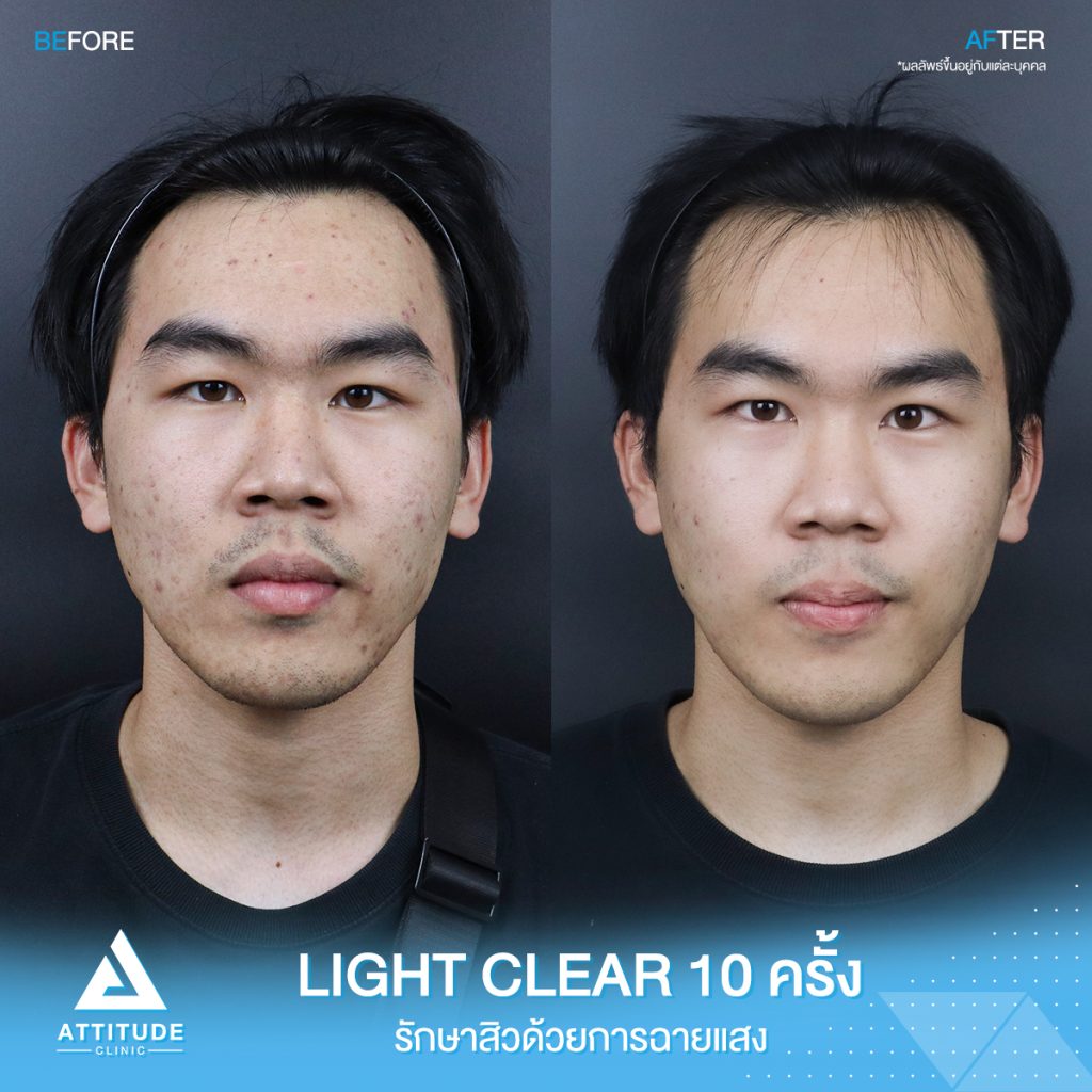 สิวเยอะแค่ไหนก็ไม่กลัว! รีวิวรักษาสิวด้วยการฉายแสงโปรแกรม Light Clear 7 ขั้นตอน จำนวน 10 ครั้ง ของน้องพอล มีปัญหาสิวและรอยสิวจัดเต็ม